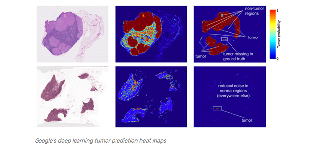 Machine Learning in Health Malignancy Ratecare 